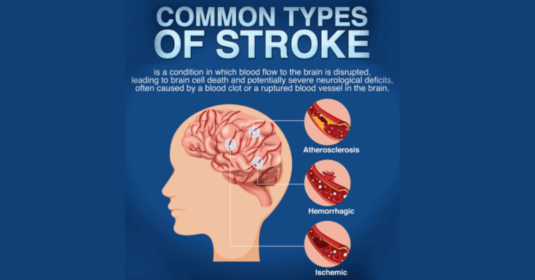 TMS for Stroke: A Breakthrough Therapy for Stroke Rehabilitation